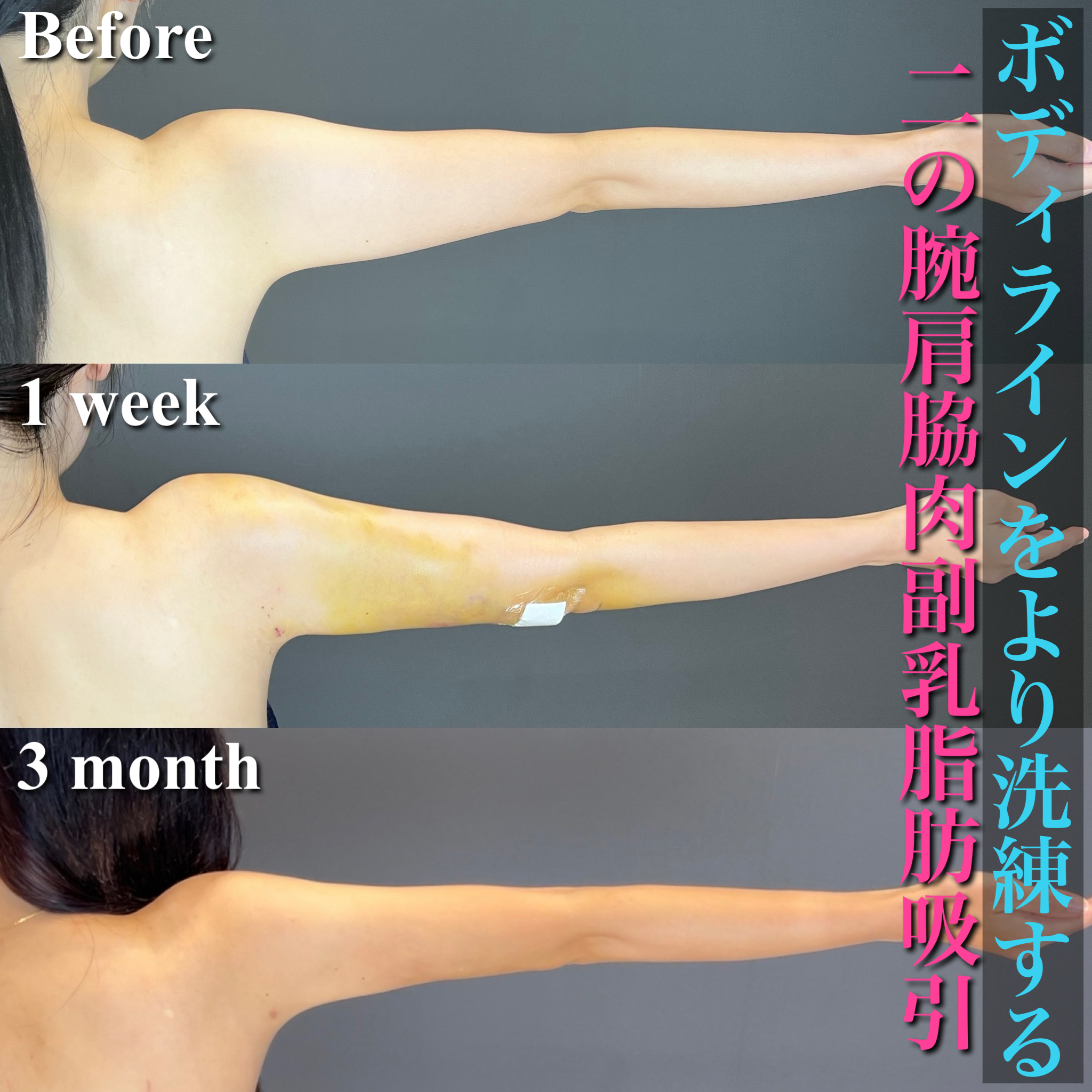 副乳 ベイザー脂肪吸引(二の腕+脇肉+副乳)/女性(20代)/術後3ヵ月 – 2024年9月 - 脂肪吸引、豊胸ならグラシアクリニック銀座 (Casa de  GRACIA GINZA)